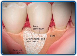 Bone Grafting